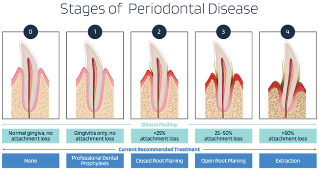 Stages of Periodontal Disease