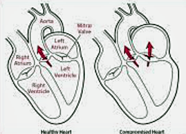 Left Atrium Enlargement